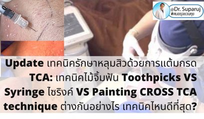 Update เทคนิครักษาหลุมสิวด้วยการแต้มกรด TCA: เทคนิคไม้จิ้มฟัน Toothpicks VS Syringe ไซริงค์ VS Painting CROSS TCA technique ต่างกันอย่างไร เทคนิคไหนดีที่สุด? https://youtu.be/CGeVtG64Elo