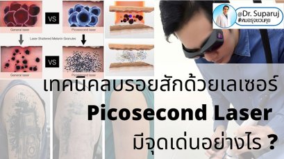 เทคนิคลบรอยสักด้วยเลเซอร์ Picosecond Laser มีจุดเด่นอย่างไร ?