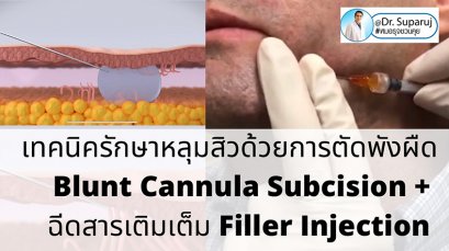 เทคนิคดูแลหลุมสิวด้วยการตัดพังผืดหลุมสิว Blunt Cannula Subcision ร่วมกับการฉีดสารเติมเต็ม Filler Injection