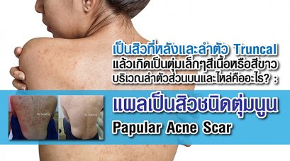 เป็นสิวที่หลังและลำตัว Truncal แล้วเกิดเป็นตุ่มเล็กๆสีเนื้อหรือสีขาว บริเวณลำตัวส่วนบนและไหล่คืออะไร? : แผลเป็นสิวชนิดตุ่มนูน Papular Acne Scar