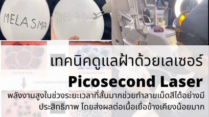 Picosecond Laser เทคโนโลยีพลังงานสูงในช่วงระยะเวลาที่สั้นมากช่วยทำลายเม็ดสีได้อย่างมีประสิทธิภาพ โดยส่งผลต่อเนื้อเยื่อข้างเคียงน้อยมาก