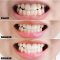 Median Dental IQ Tartar Care Toothpaste 93% #Original (สีน้ำเงิน) NEW!