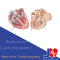 Restrictive Cardiomyopathy