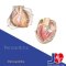 Pericarditis