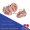 Ventricular Septal Defect (VSDs)