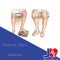 Charcot Joint