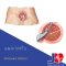 Pressure Ulcers 