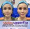 upperfix