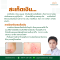 สะเก็ดเงิน (Psoriasis)