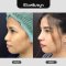 รีวิวศัลยกรรมจมูก