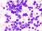 Causes and Diagnosis of Multiple Myeloma
