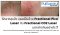 เจาะลึกความแตกต่าง: Fractional CO2 vs Fractional Picosecond Laser ในการรักษาหลุมสิว