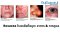 Rosacea โรเซเชียที่จมูก: อาการ & การดูแล