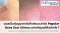 แผลเป็นตุ่นนูนจากสิวที่หลังและลำตัว Papular Acne Scar มีลักษณะอย่างไรดูแลได้อย่างไร ?