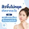 สิวขึ้นไม่หยุด เกิดจากอะไร และพฤติกรรมไหนที่ควรหยุดทันที?